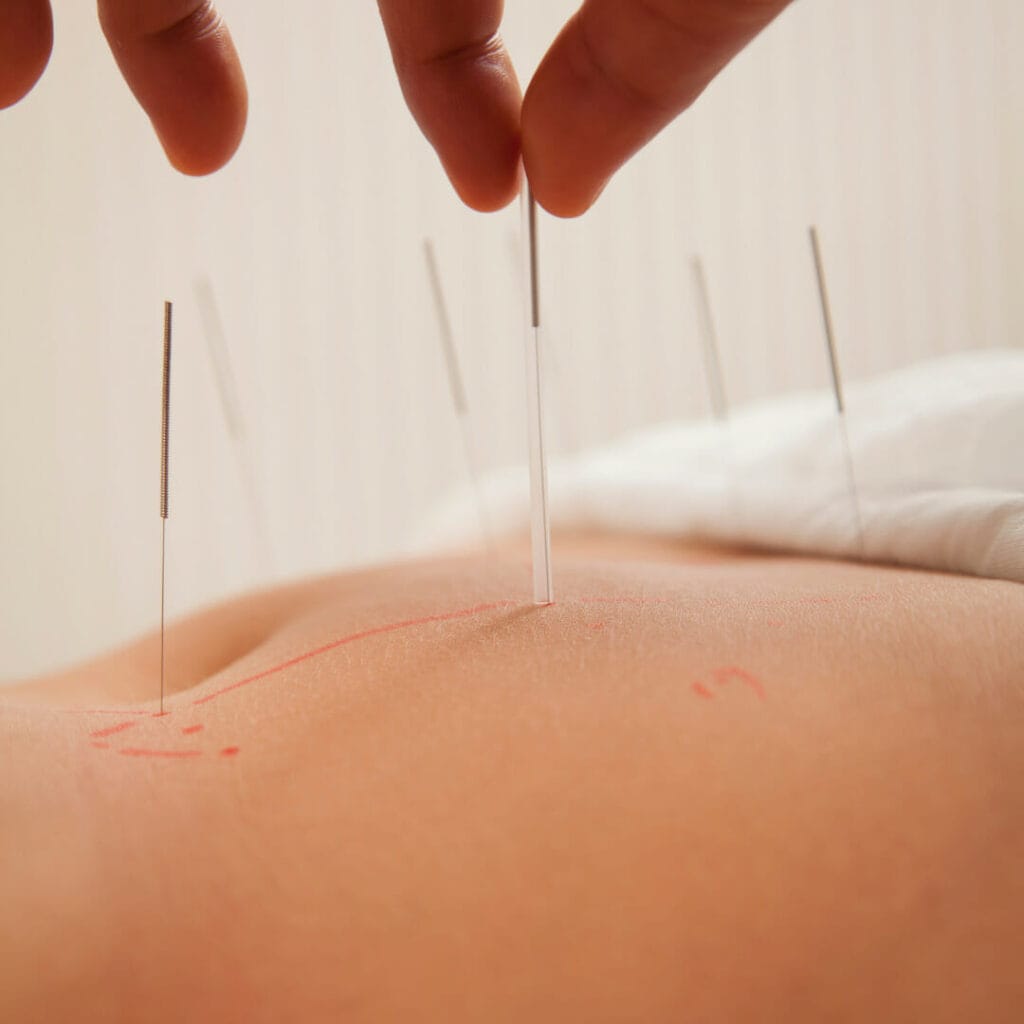 Comment améliorer votre sommeil grâce à l'acupuncture ?